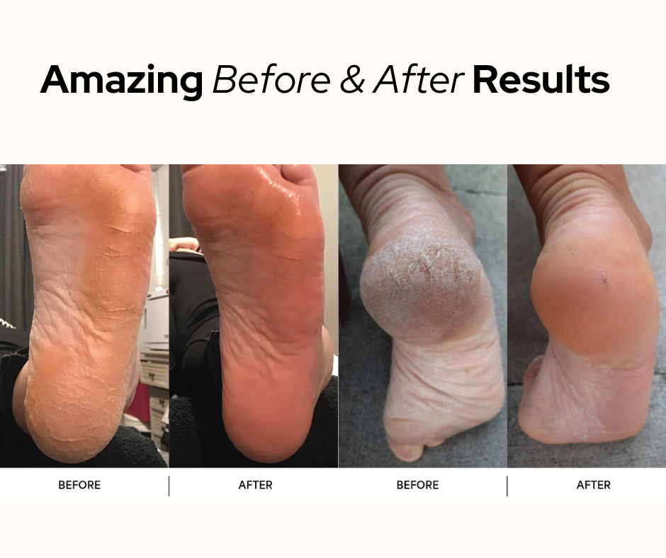 The Callus Remover™